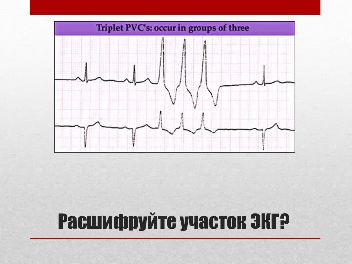 Расшифруйте участок ЭКГ?