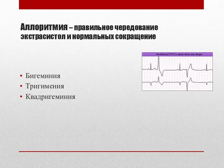 Аллоритмия – правильное чередование экстрасистол и нормальных сокращение Бигеминия Тригимения Квадригеминия