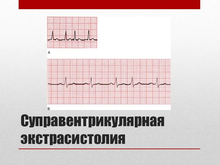 Суправентрикулярная экстрасистолия