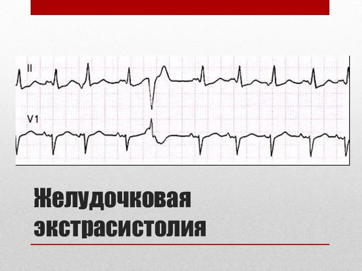 Желудочковая экстрасистолия