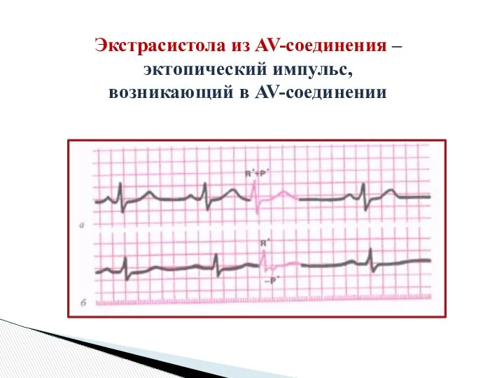 Экстрасистола из AV-соединения – эктопический импульс, возникающий в AV-соединении