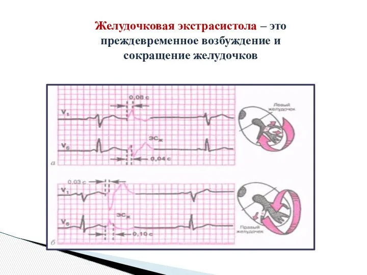 Желудочковая экстрасистола – это преждевременное возбуждение и сокращение желудочков