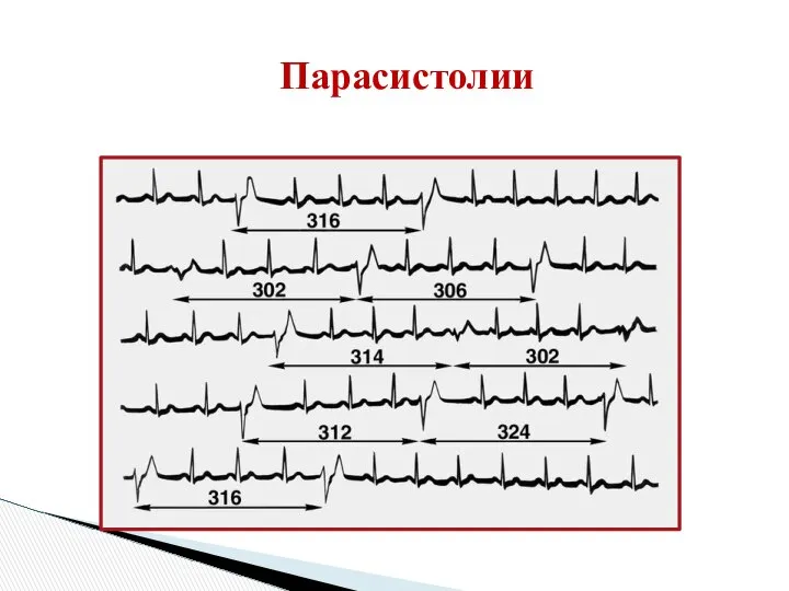 Парасистолии