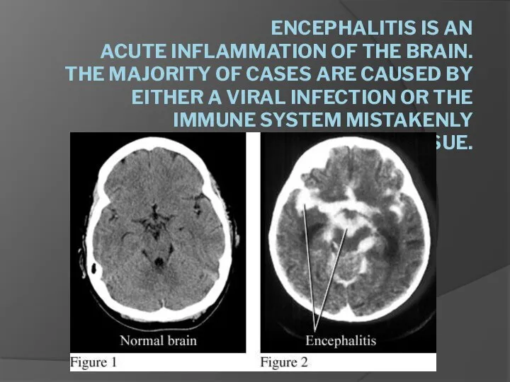 ENCEPHALITIS IS AN ACUTE INFLAMMATION OF THE BRAIN. THE MAJORITY OF