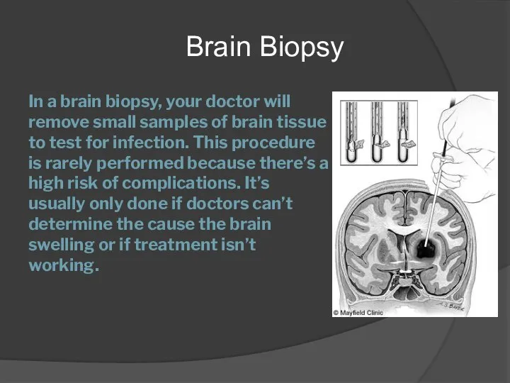 In a brain biopsy, your doctor will remove small samples of