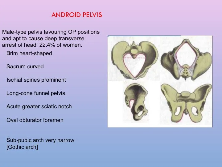 Male-type pelvis favouring OP positions and apt to cause deep transverse