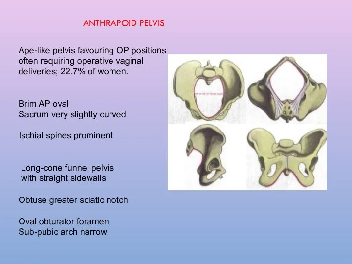 Ape-like pelvis favouring OP positions often requiring operative vaginal deliveries; 22.7%