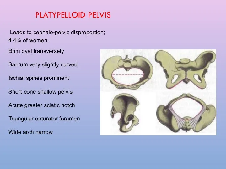 PLATYPELLOID PELVIS Leads to cephalo-pelvic disproportion; 4.4% of women. Brim oval