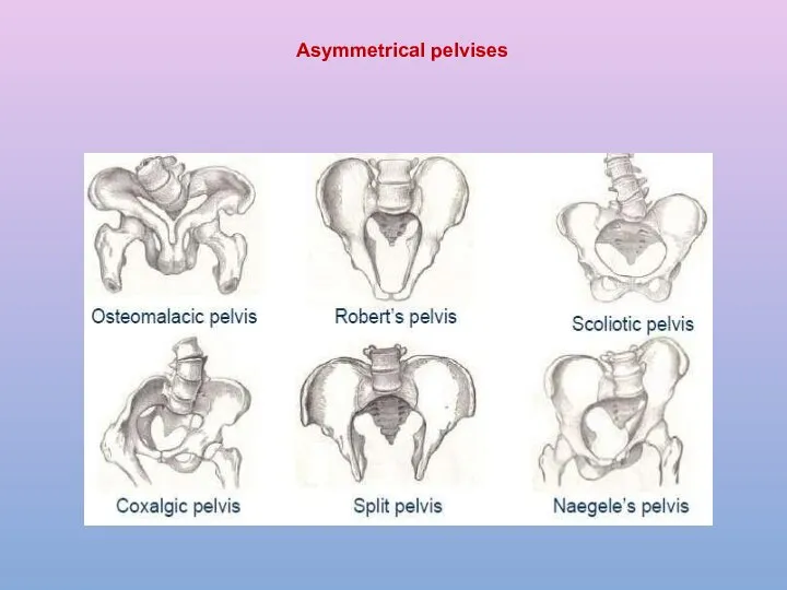 Asymmetrical pelvises