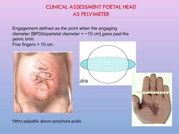 Engagement defined as the point when the engaging diameter [BPD(biparietal diameter