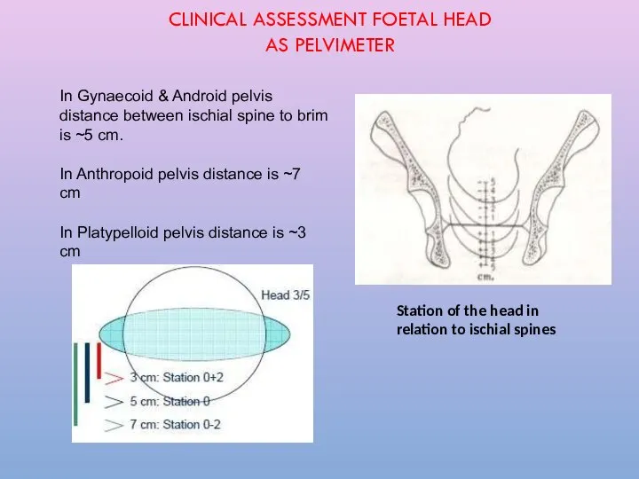 In Gynaecoid & Android pelvis distance between ischial spine to brim