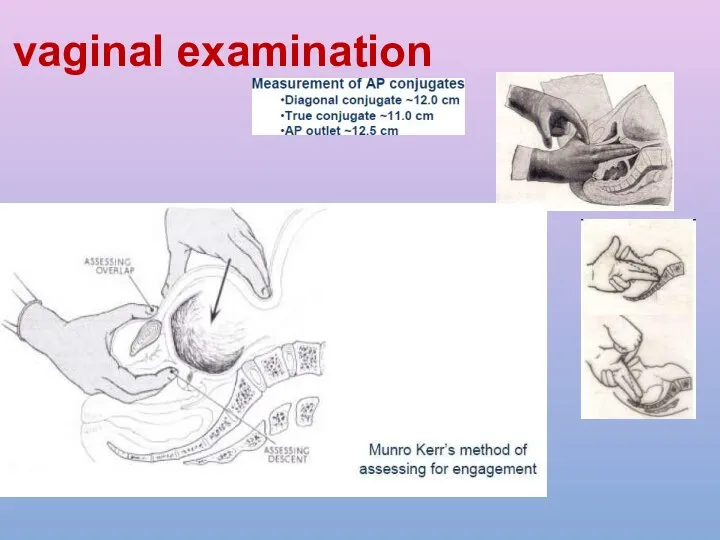 vaginal examination