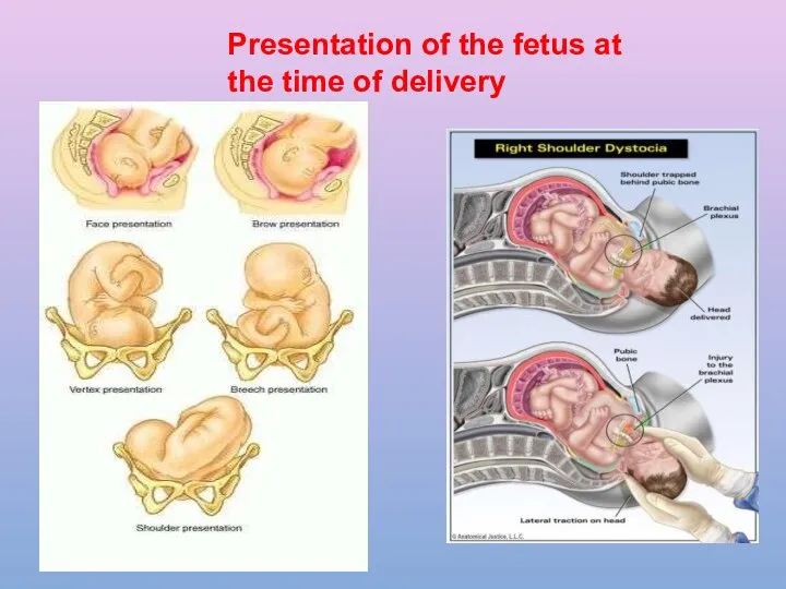 Presentation of the fetus at the time of delivery