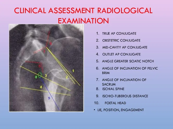 CLINICAL ASSESSMENT RADIOLOGICAL EXAMINATION TRUE AP CONJUGATE OBSTETRIC CONJUGATE MID-CAVITY AP