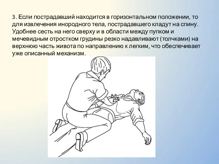 3. Если пострадавший находится в горизонтальном положении, то для извлечения инородного