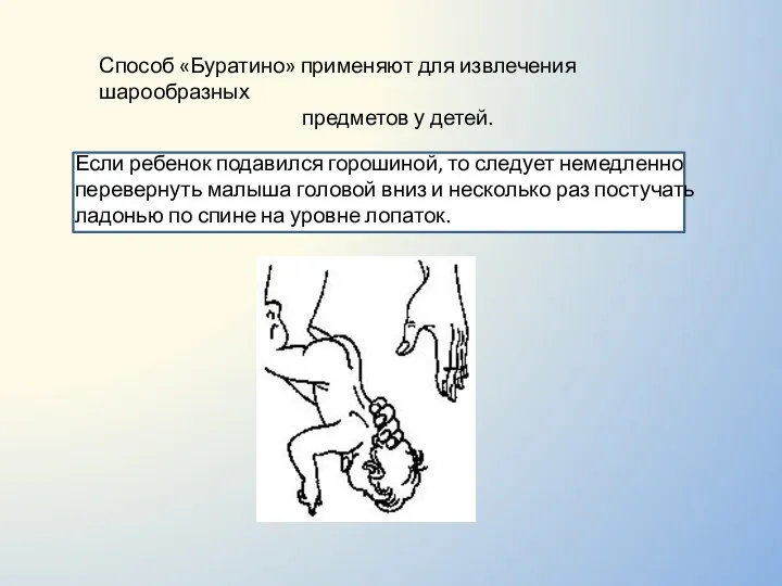 Способ «Буратино» применяют для извлечения шарообразных предметов у детей. Если ребенок