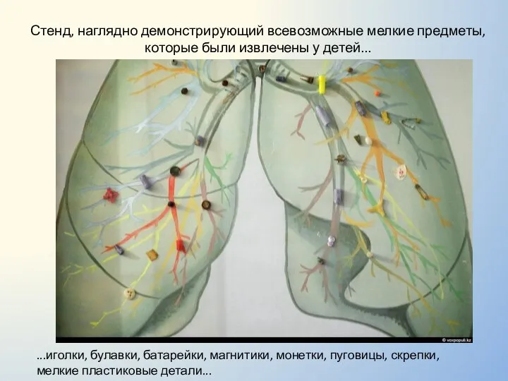 Стенд, наглядно демонстрирующий всевозможные мелкие предметы, которые были извлечены у детей...