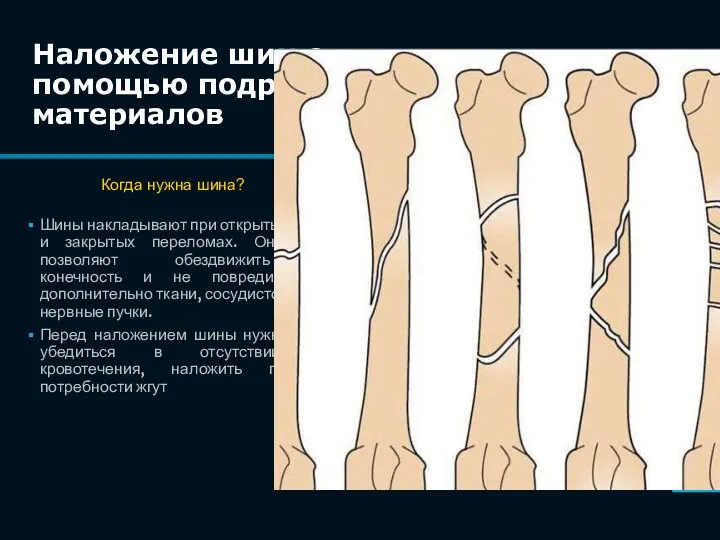 Шины накладывают при открытых и закрытых переломах. Они позволяют обездвижить конечность