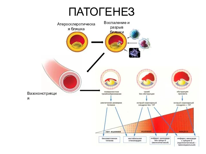 ПАТОГЕНЕЗ Атеросклеротическая бляшка Воспаление и разрыв бляшки Вазоконстрикция