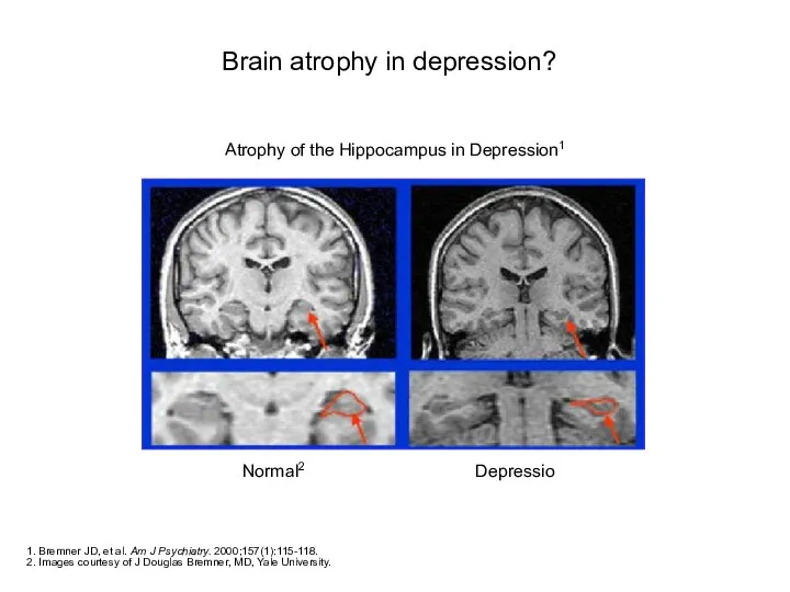 Brain atrophy in depression? 1. Bremner JD, et al. Am J