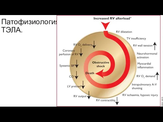 Патофизиология ТЭЛА.