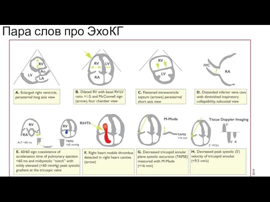 Пара слов про ЭхоКГ