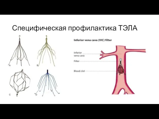 Специфическая профилактика ТЭЛА