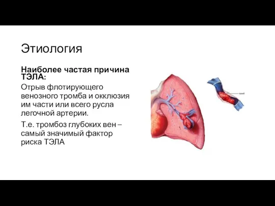 Этиология Наиболее частая причина ТЭЛА: Отрыв флотирующего венозного тромба и окклюзия