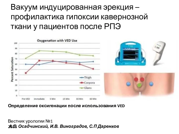 Вакуум индуцированная эрекция – профилактика гипоксии кавернозной ткани у пациентов после