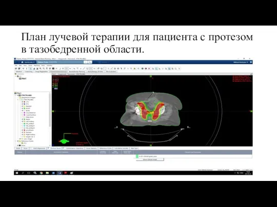 План лучевой терапии для пациента с протезом в тазобедренной области.