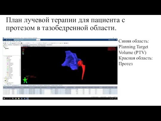 План лучевой терапии для пациента с протезом в тазобедренной области. Синяя