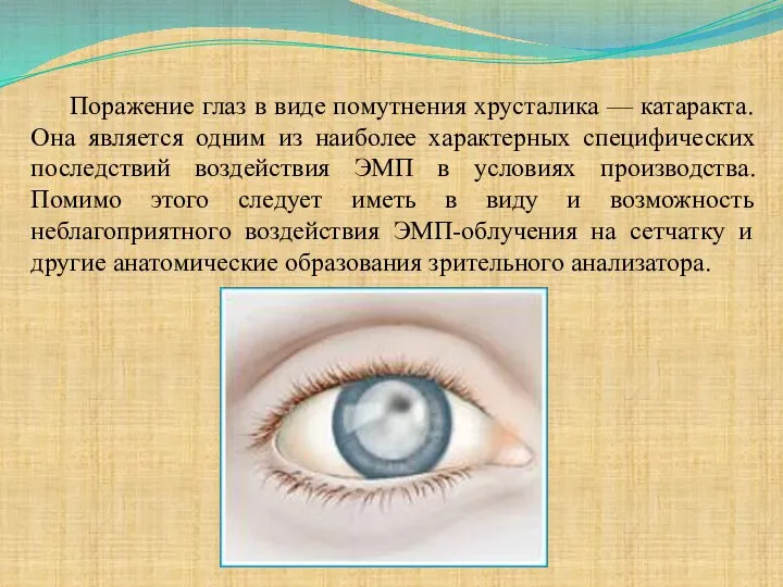 Поражение глаз в виде помутнения хрусталика — катаракта. Она является одним