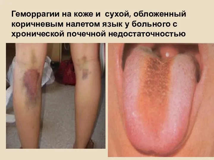 Геморрагии на коже и сухой, обложенный коричневым налетом язык у больного с хронической почечной недостаточностью