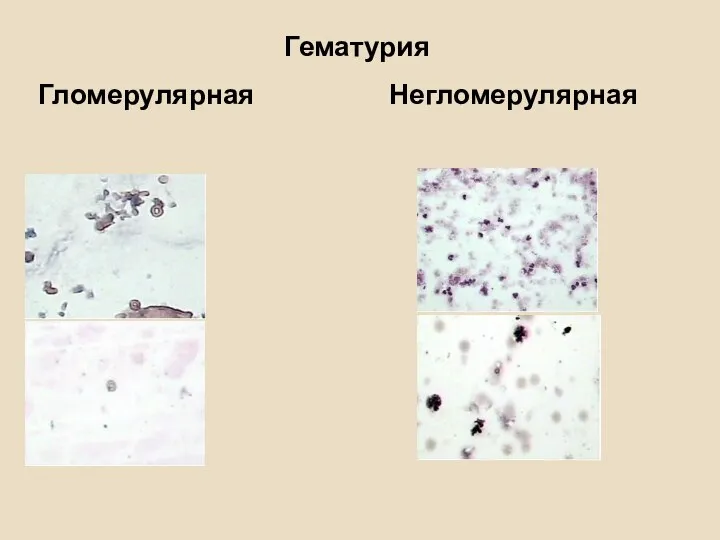 Гематурия Гломерулярная Негломерулярная