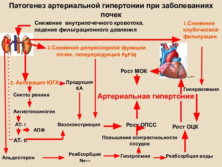 Патогенез артериальной гипертонии при заболеваниях почек Снижение внутрипочечного кровотока, падение фильтрационного