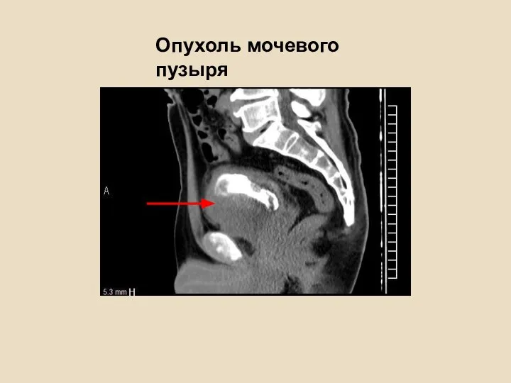 Опухоль мочевого пузыря