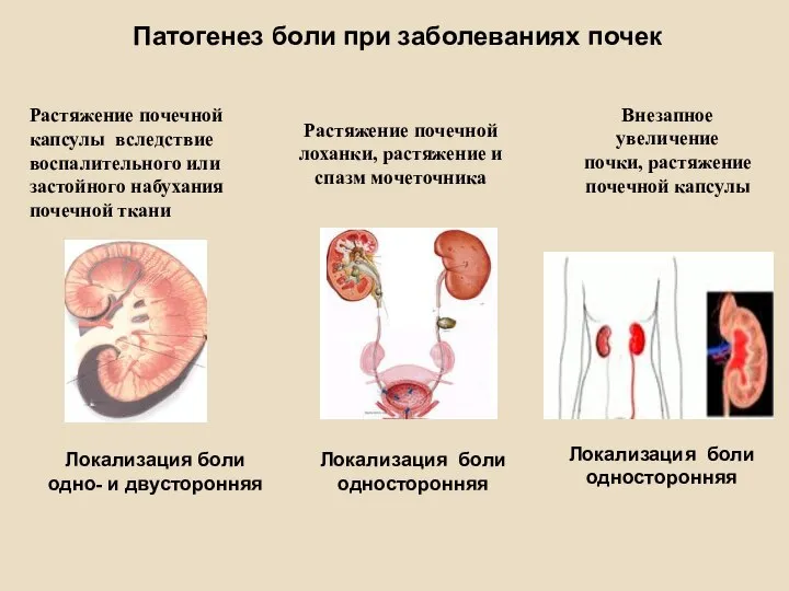 Патогенез боли при заболеваниях почек Растяжение почечной капсулы вследствие воспалительного или