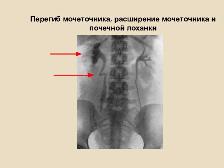 Перегиб мочеточника, расширение мочеточника и почечной лоханки