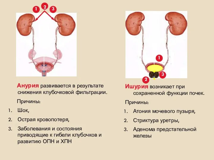 Анурия развивается в результате снижения клубочковой фильтрации. Причины: Шок, Острая кровопотеря,