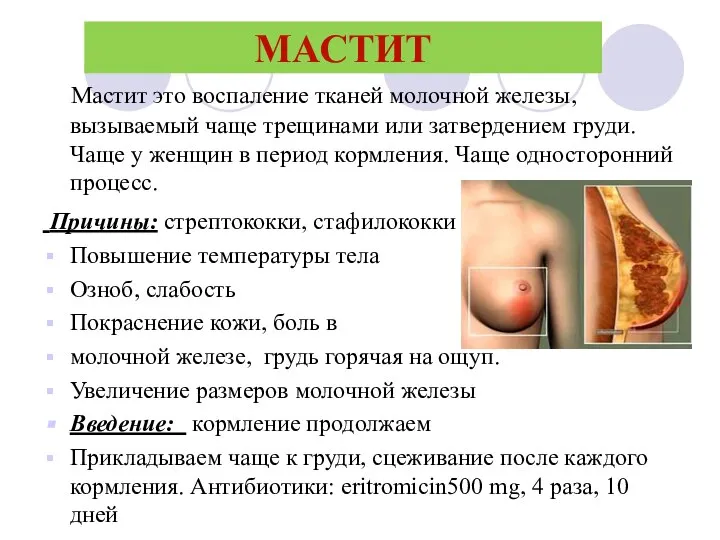 МАСТИТ Мастит это воспаление тканей молочной железы, вызываемый чаще трещинами или