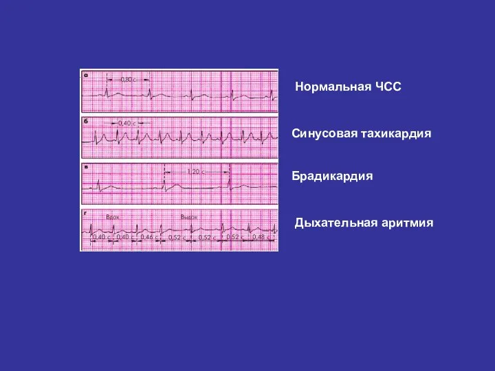 Нормальная ЧСС Синусовая тахикардия Брадикардия Дыхательная аритмия