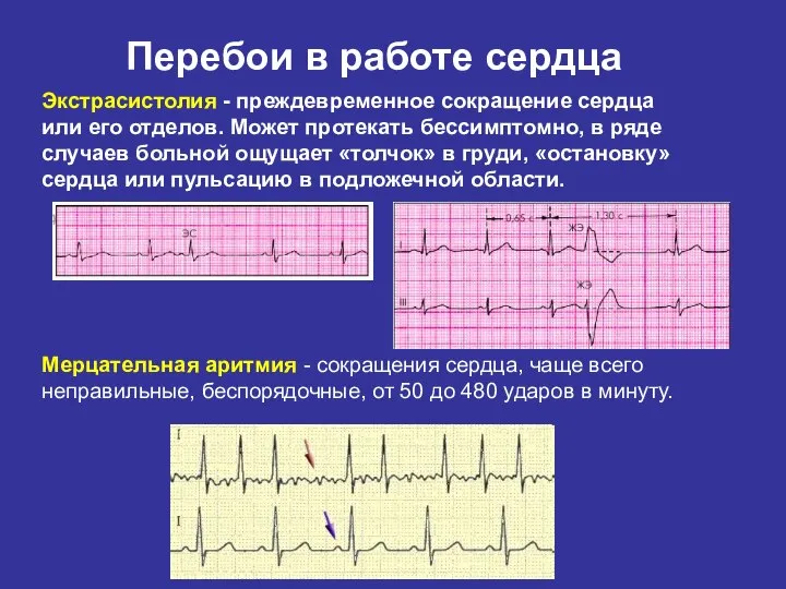 Экстрасистолия - преждевременное сокращение сердца или его отделов. Может протекать бессимптомно,