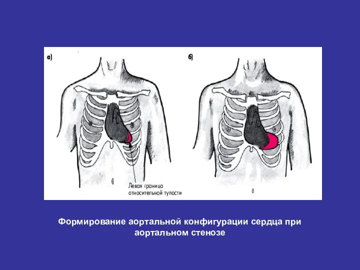 Формирование аортальной конфигурации сердца при аортальном стенозе