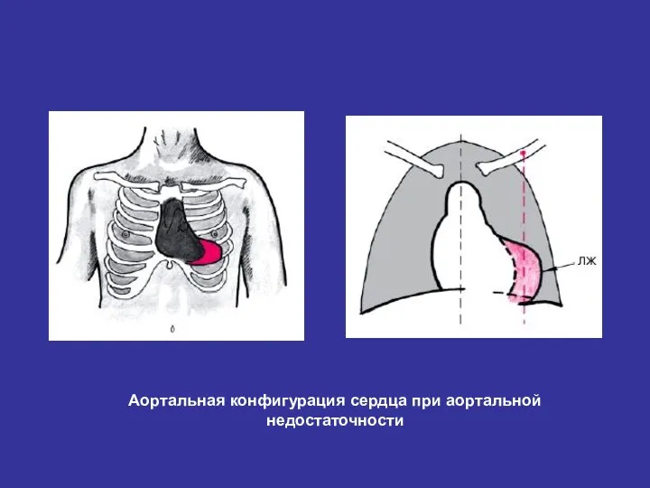 Аортальная конфигурация сердца при аортальной недостаточности