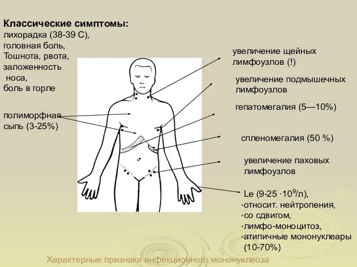 Характерные признаки инфекционного мононуклеоза