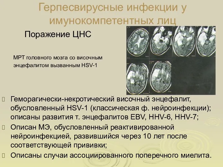 Герпесвирусные инфекции у имунокомпетентных лиц Поражение ЦНС МРТ головного мозга со