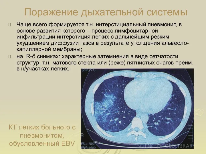 Поражение дыхательной системы Чаще всего формируется т.н. интерстициальный пневмонит, в основе