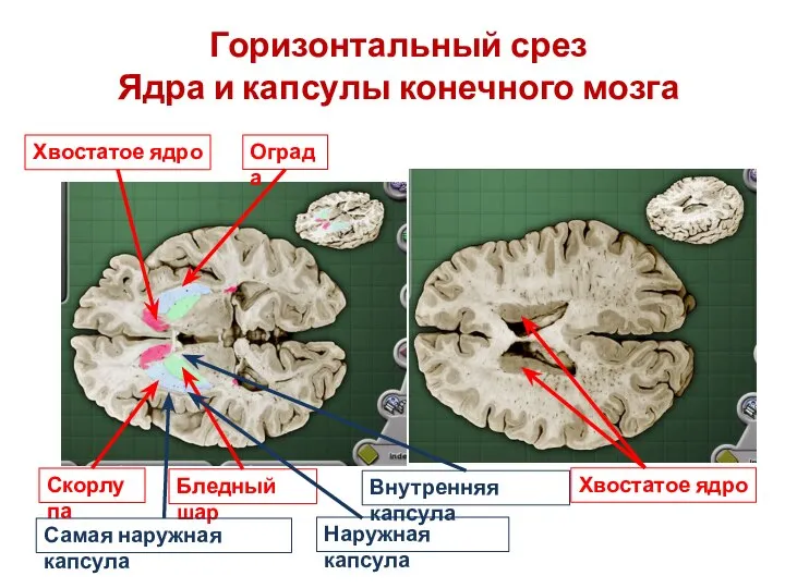 Горизонтальный срез Ядра и капсулы конечного мозга