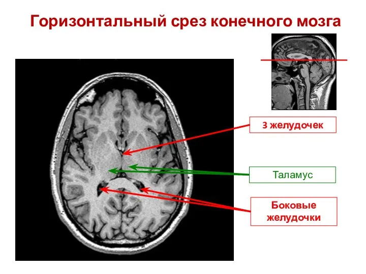 Таламус Горизонтальный срез конечного мозга Боковые желудочки 3 желудочек