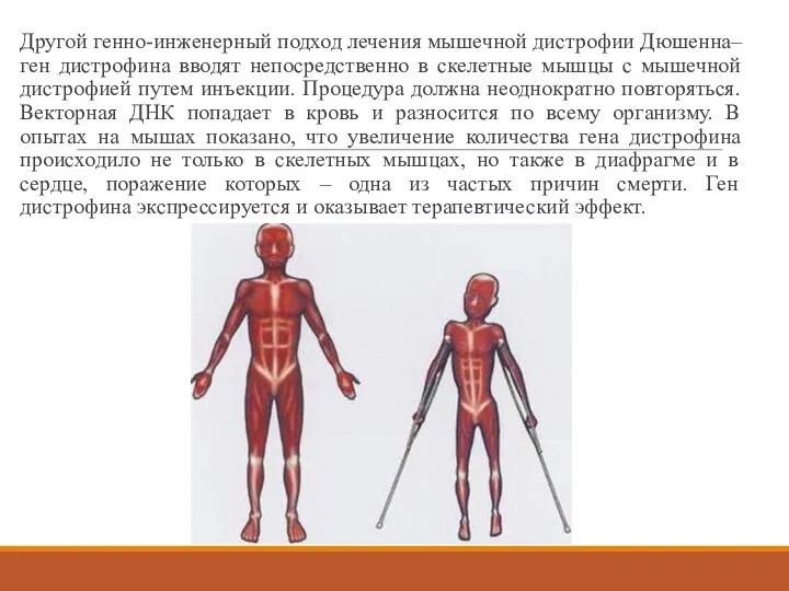 Другой генно-инженерный подход лечения мышечной дистрофии Дюшенна– ген дистрофина вводят непосредственно